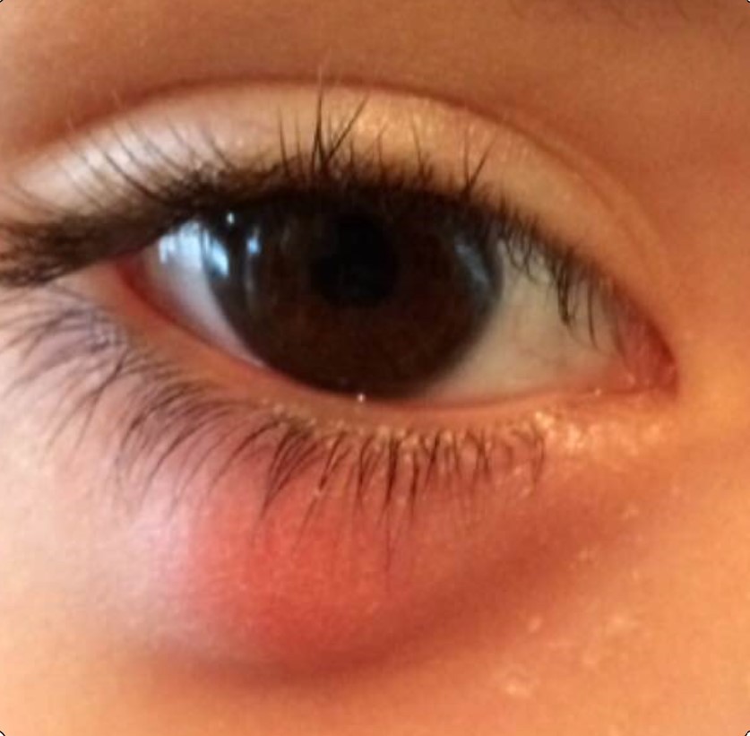 Chalazion / stye of the eyelid.prevention and treatment
