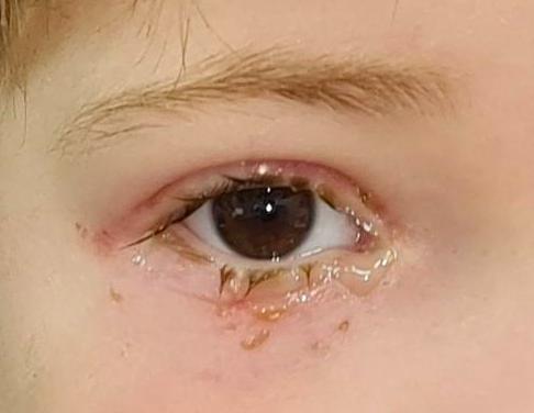 Slika 1. Krmeljanje oka zbog urođeno začepljenog suznog kanala